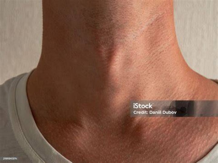 ___ Apple (Neck Protrusion)