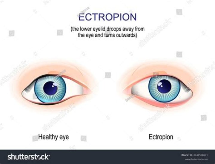 Droops