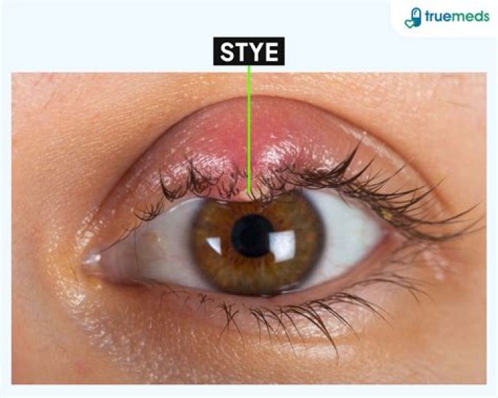 Eyelid problem