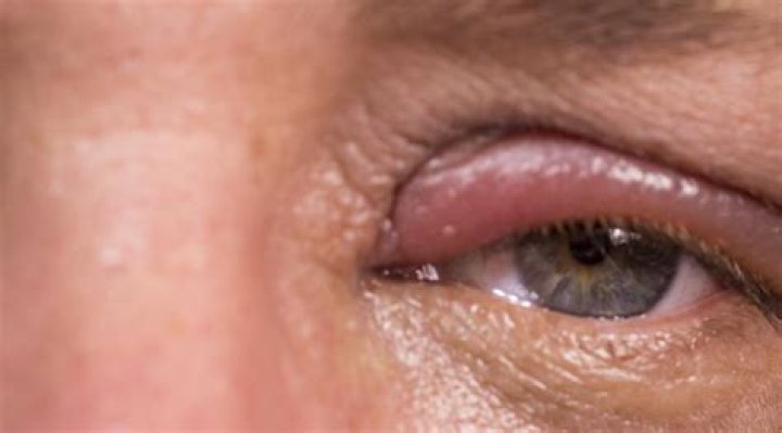 Eyelid sore