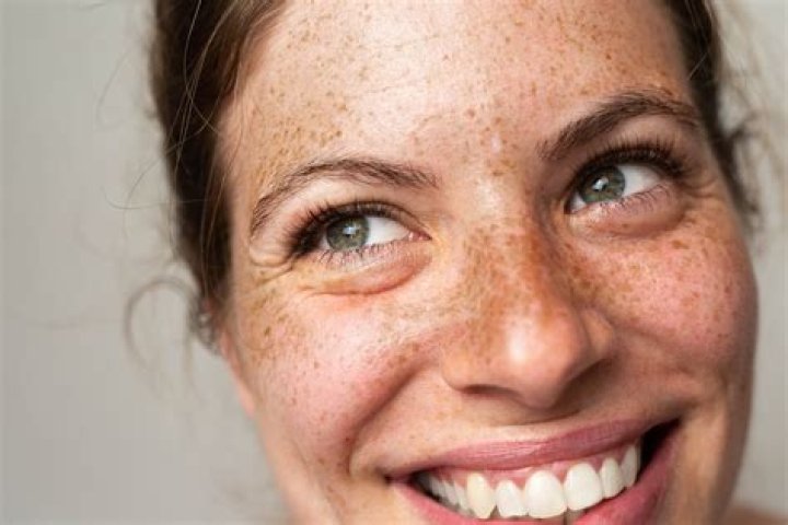 Freckle for example