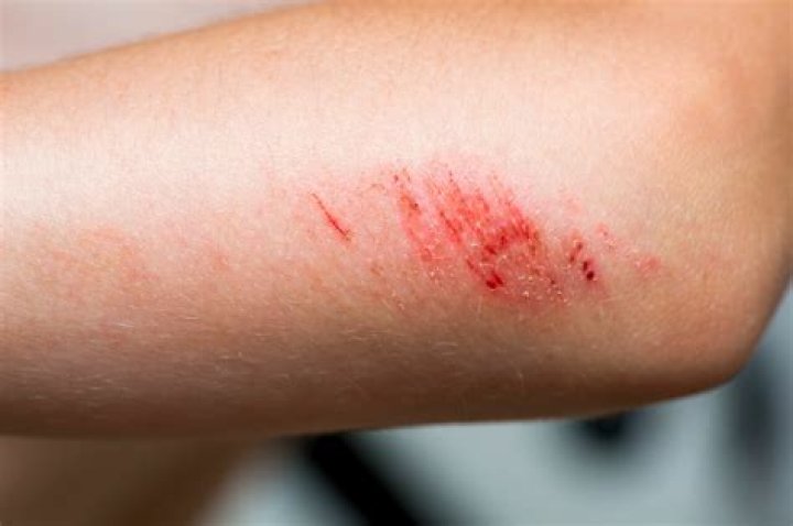 Gaping cut