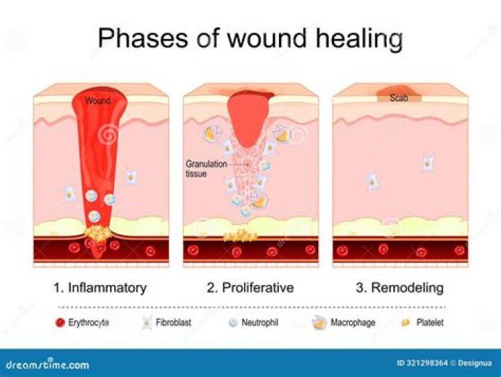 It forms over a healing wound