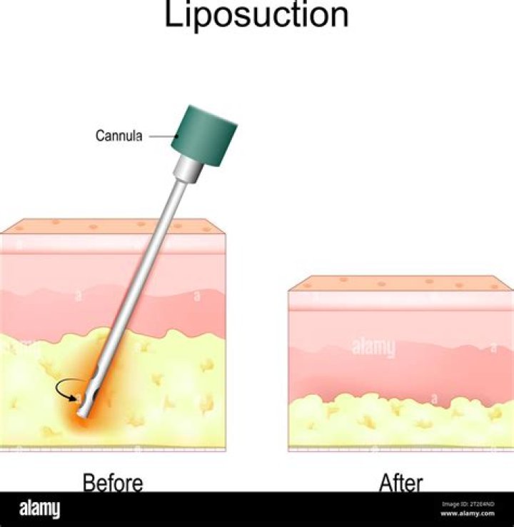 Liposuction can remove it