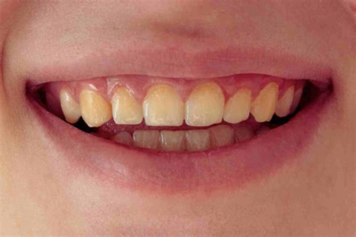 Makes less yellow like teeth