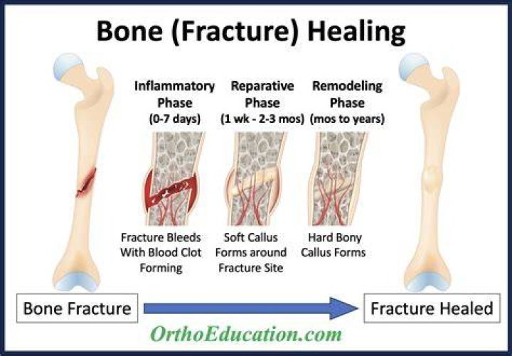 Mend as a broken bone