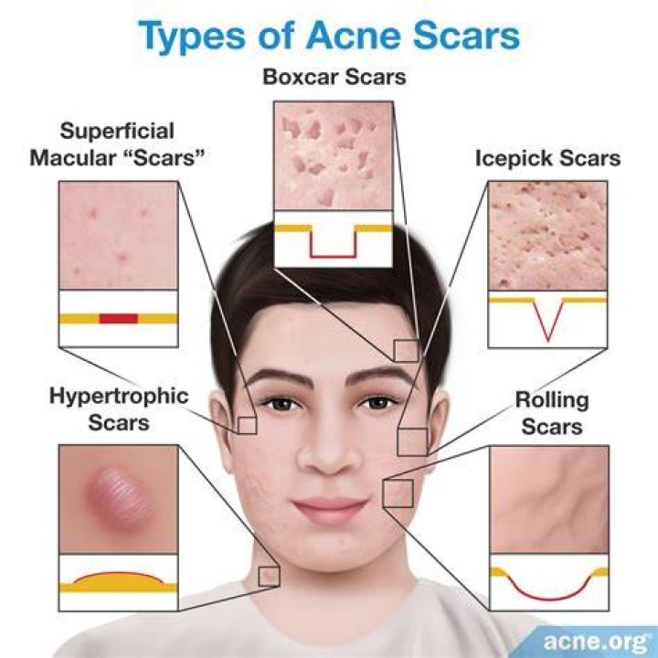 Pimple