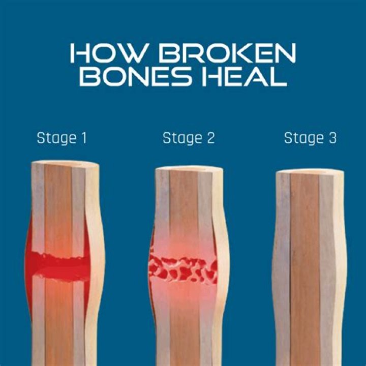 Protectors for broken bones