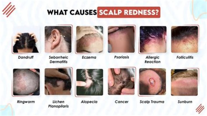 Scalp-trespassing pests