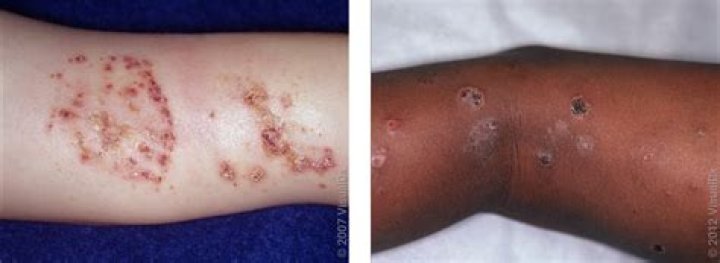 Skin openings