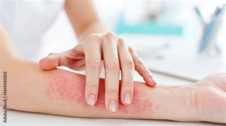 Skin outbreak