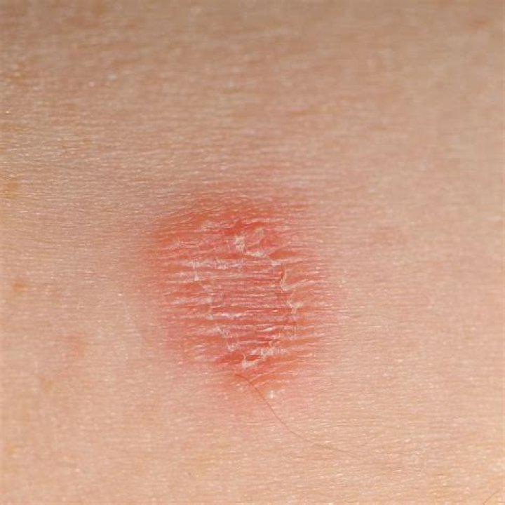 Small round marks