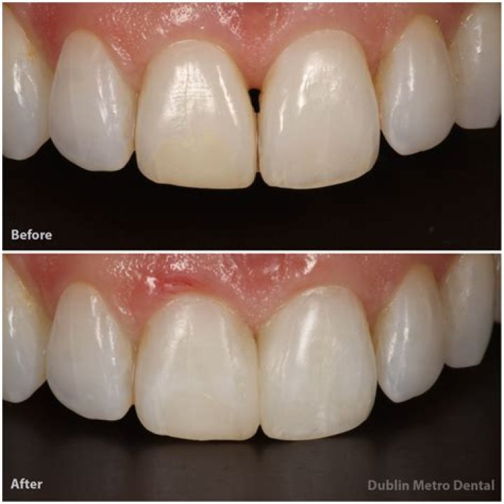Spaces as between teeth