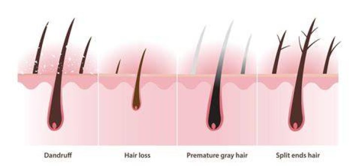 Split ___ (hair problems)