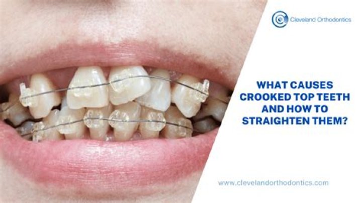 Straighten as teeth