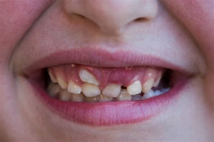 That sets my teeth on ___