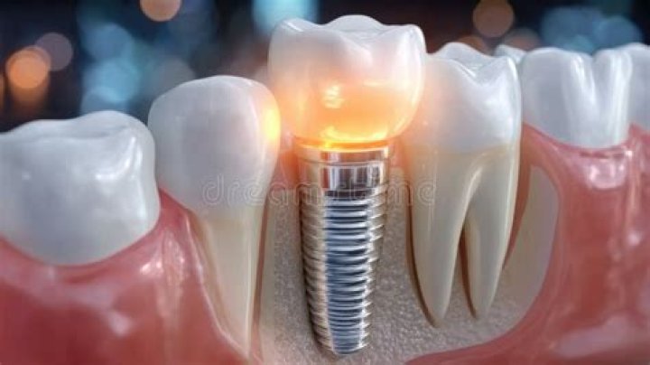 Tooth anchor